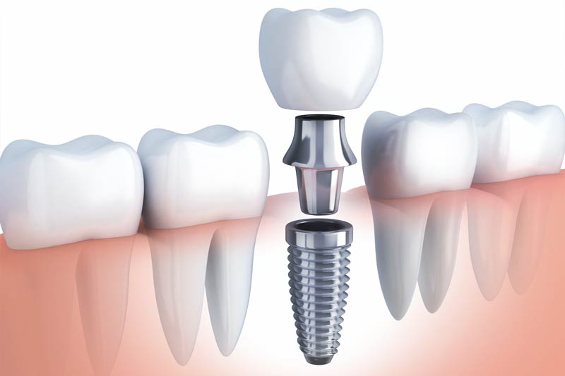 Dental Treatments in Houston