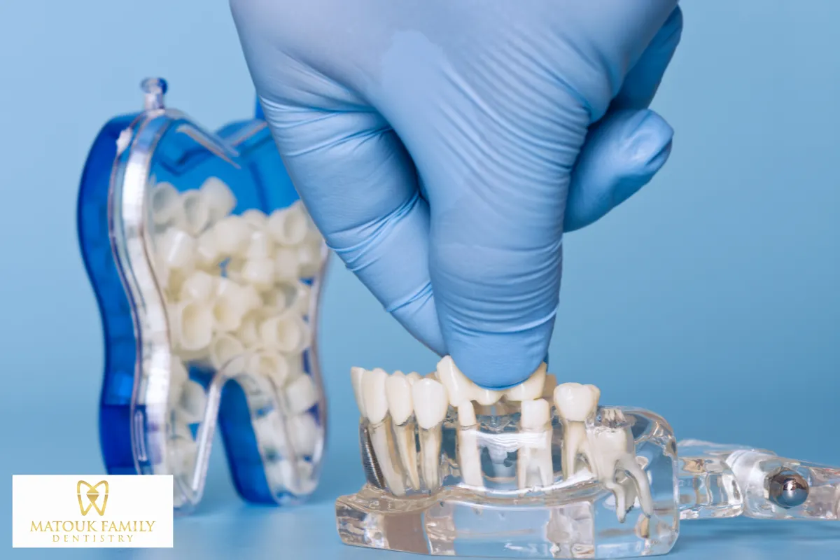 Dental Bridges