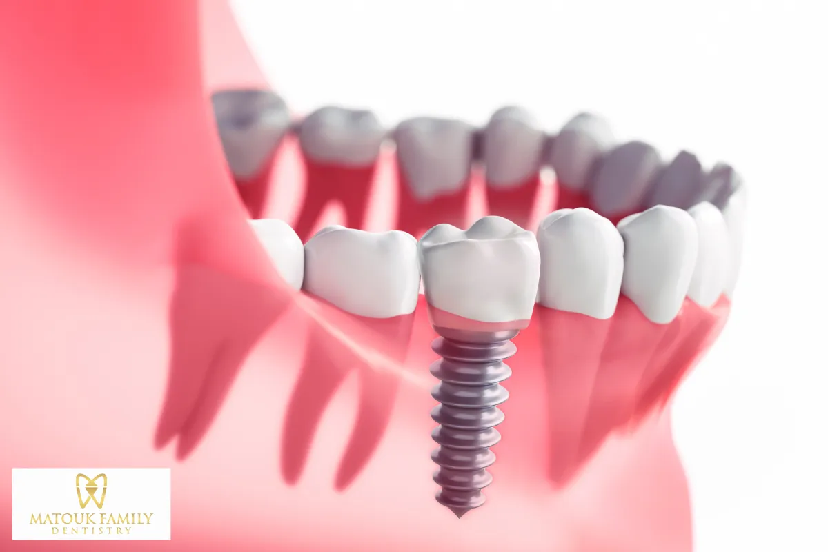 Dental Implants