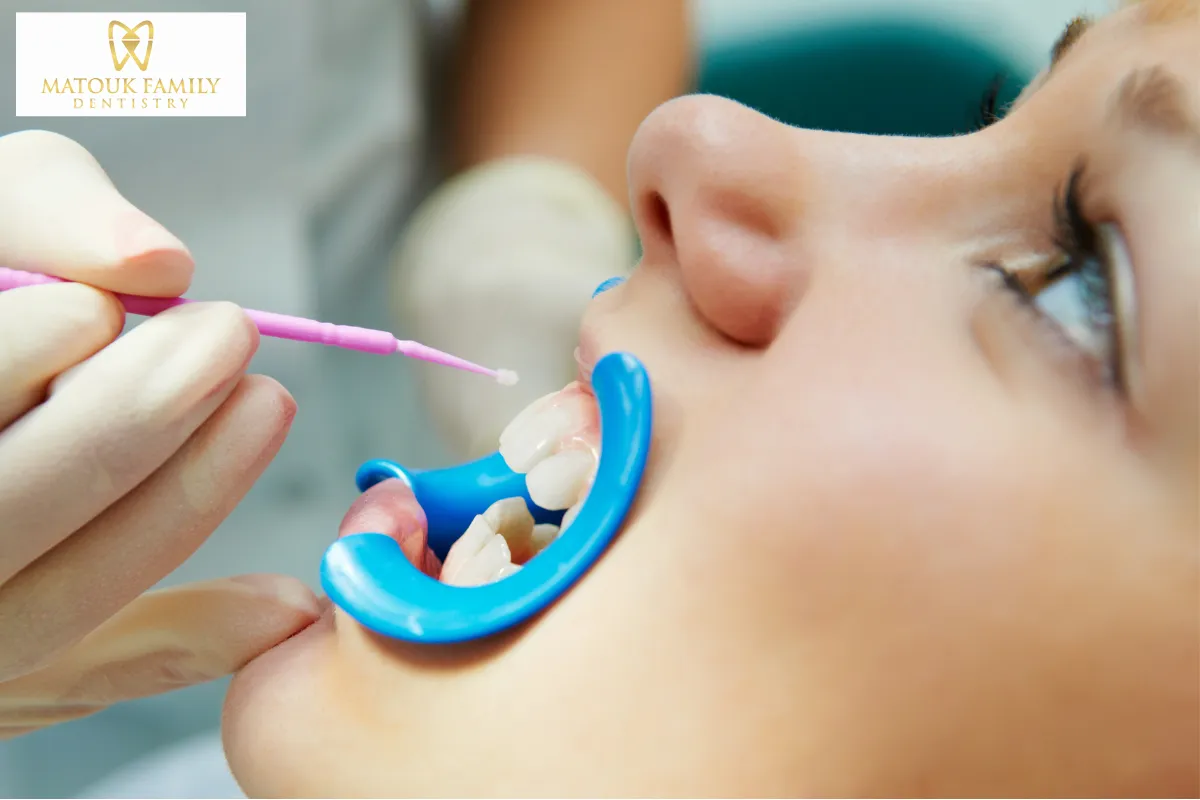 Dental Sealants