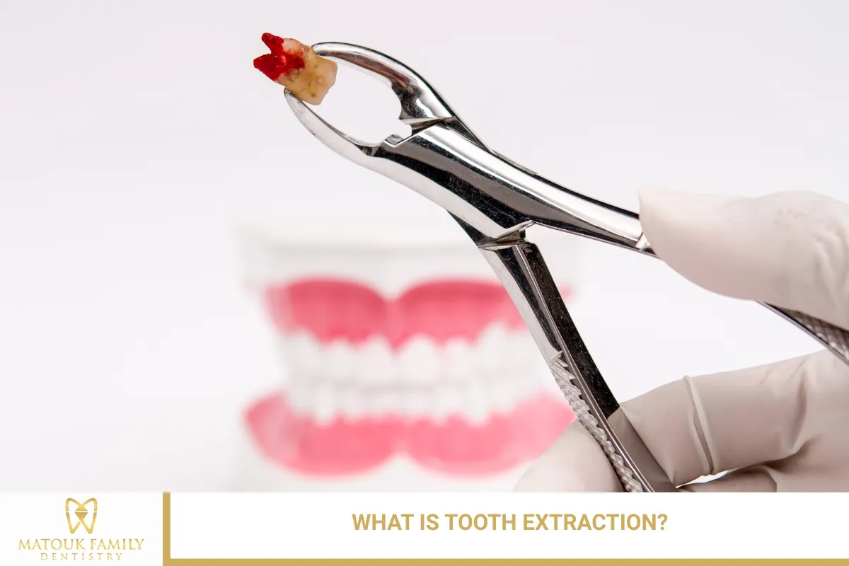 What Is Tooth Extraction?