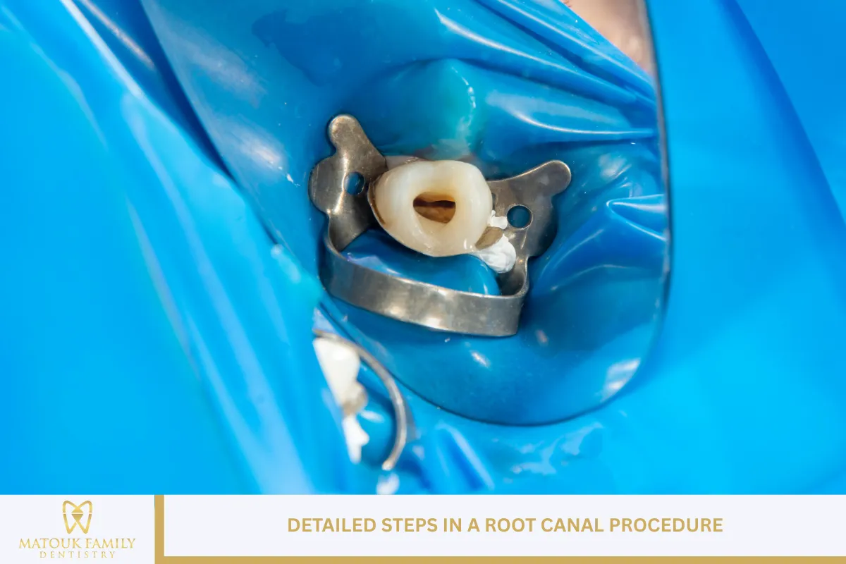 Detailed Steps in a Root Canal Procedure