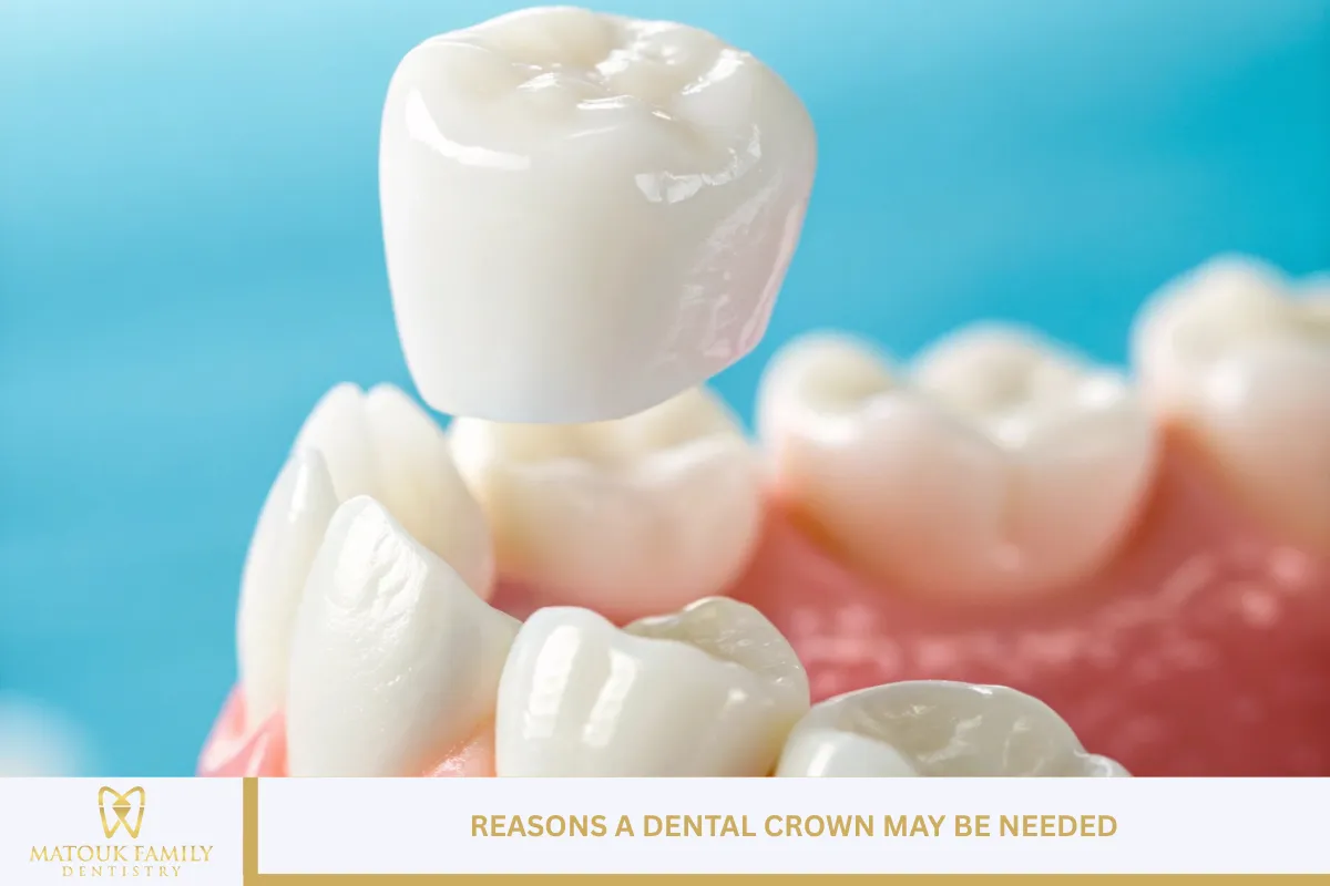 Reasons a Dental Crown May Be Needed