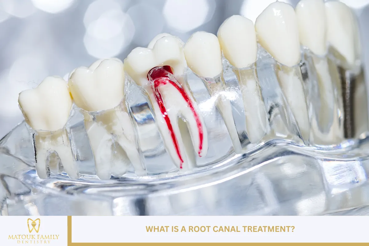 What Is a Root Canal Treatment?